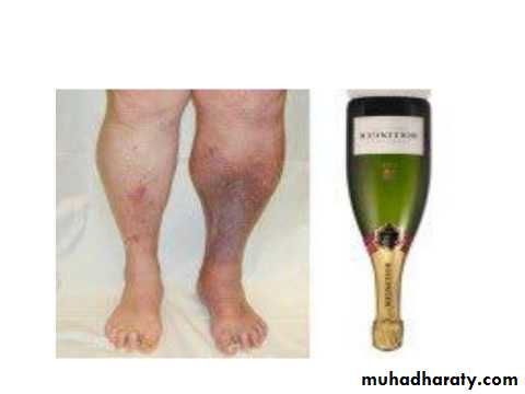ENDOGENOUS ECZEMA