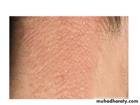 ENDOGENOUS ECZEMA