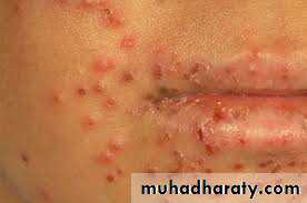 ENDOGENOUS ECZEMA