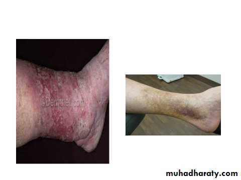 ENDOGENOUS ECZEMA