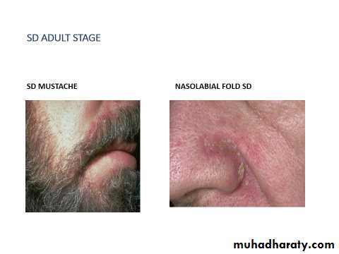 ENDOGENOUS ECZEMA