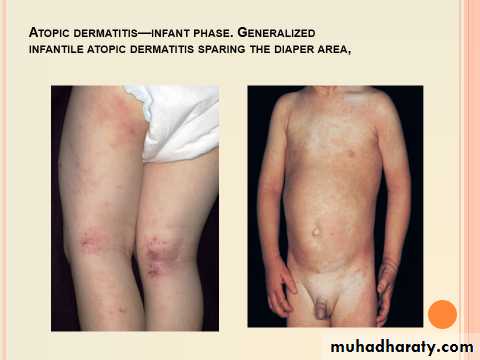 ENDOGENOUS ECZEMA