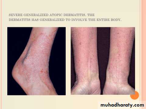 ENDOGENOUS ECZEMA