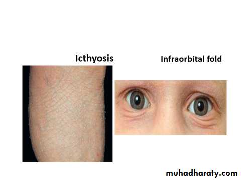 ENDOGENOUS ECZEMA