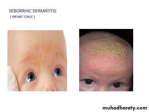 ENDOGENOUS ECZEMA