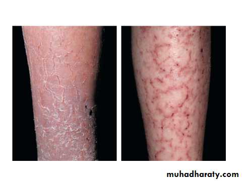 ENDOGENOUS ECZEMA