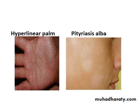 ENDOGENOUS ECZEMA