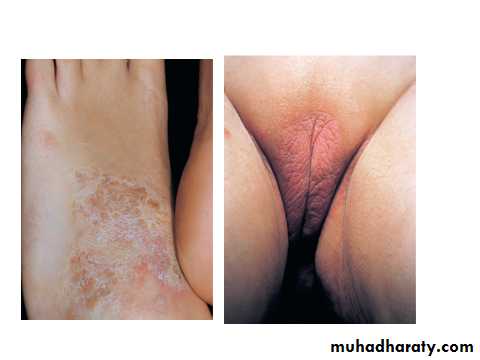 ENDOGENOUS ECZEMA