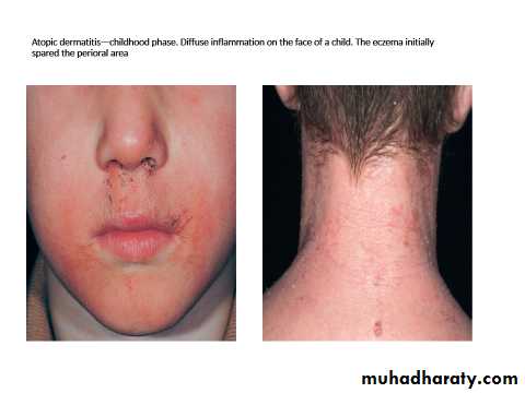ENDOGENOUS ECZEMA