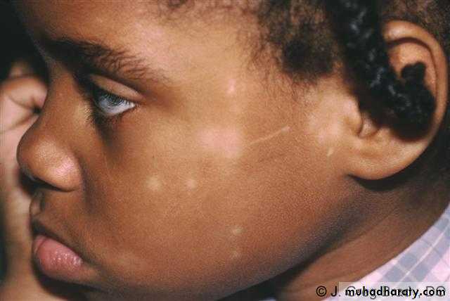 ENDOGENOUS ECZEMA