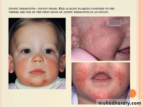 ENDOGENOUS ECZEMA