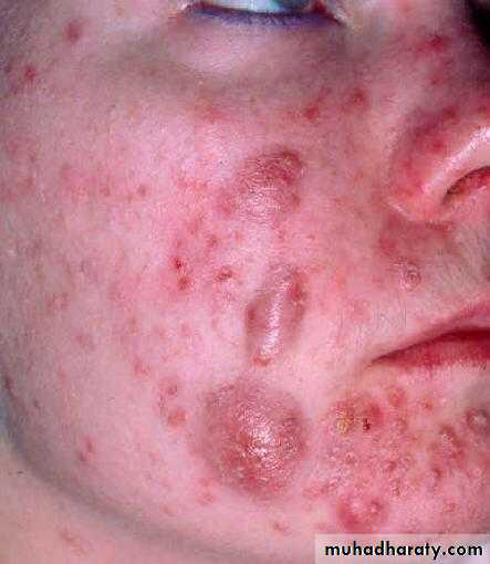 Acne