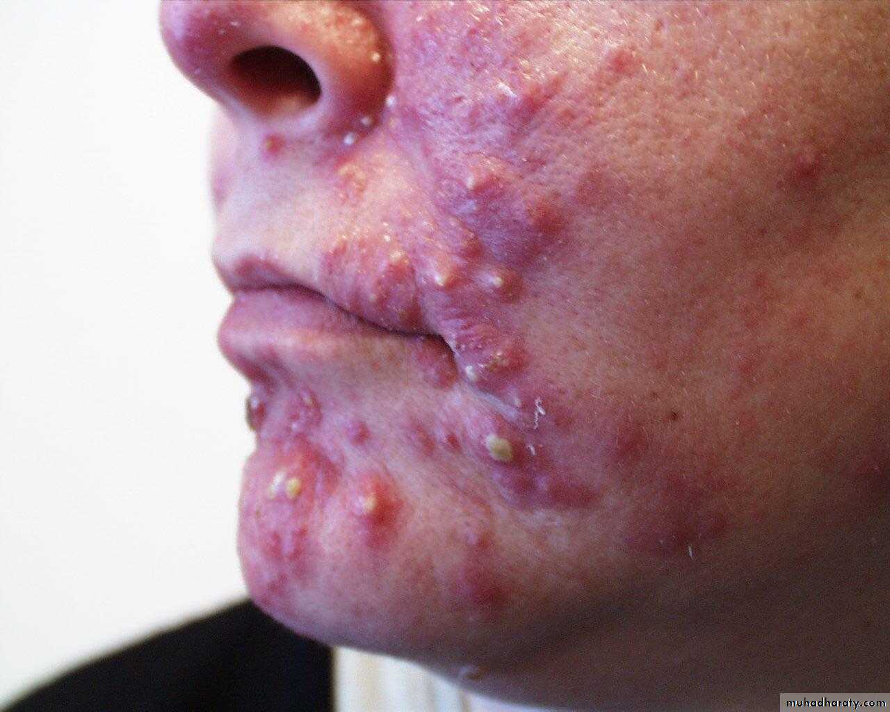 Acne