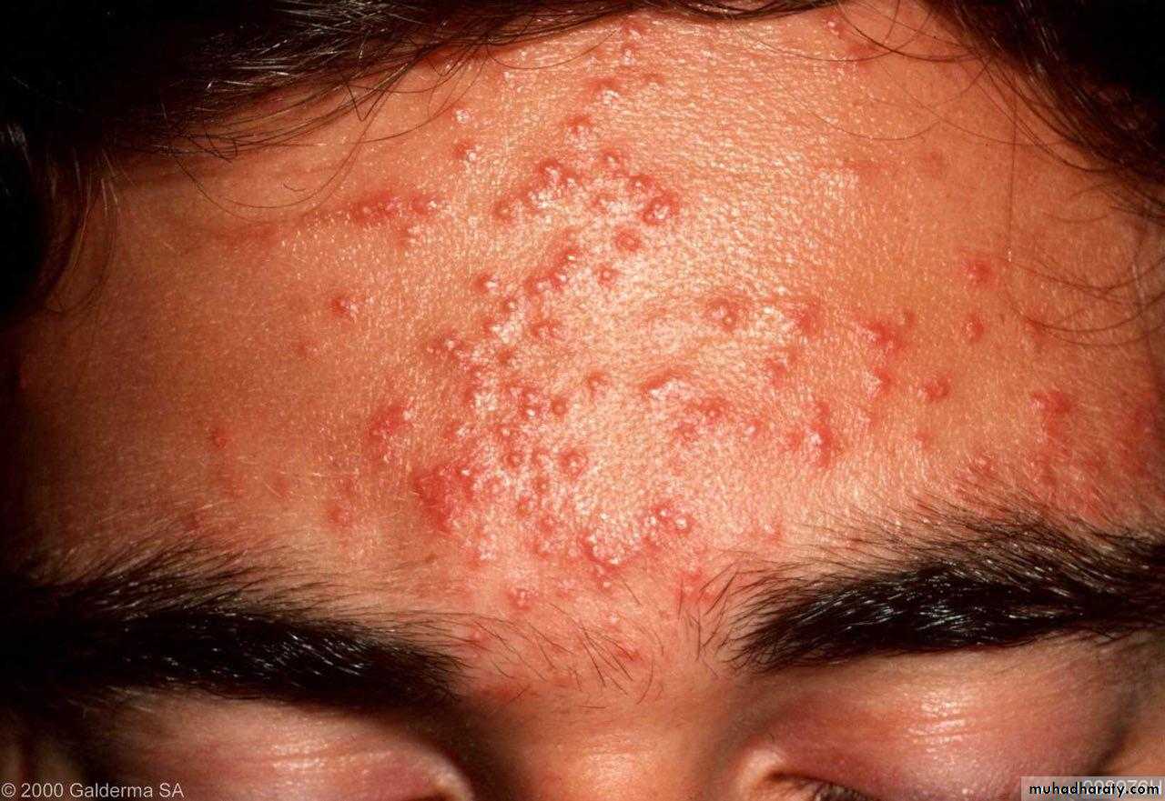 Acne