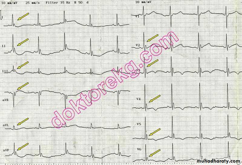 Cardio L2