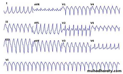Supraventricular tachycardia