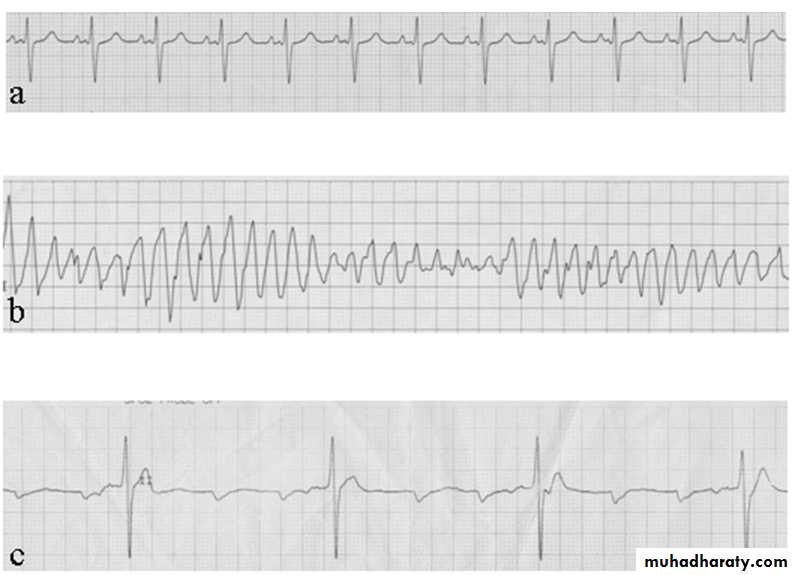 Supraventricular tachycardia