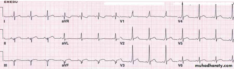 Supraventricular tachycardia