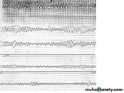 Supraventricular tachycardia