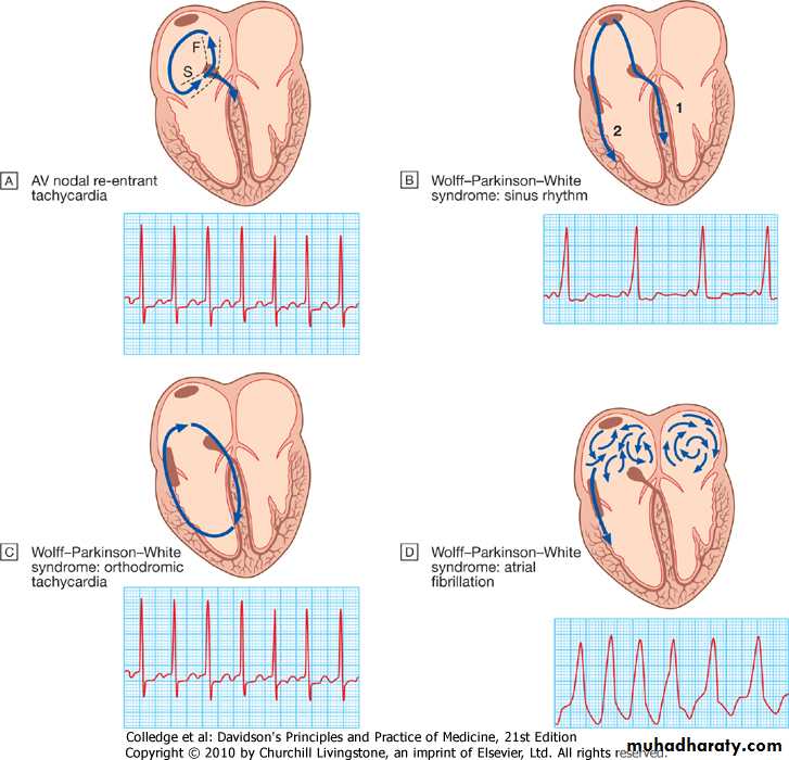 Supraventricular tachycardia