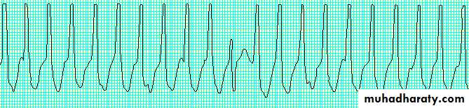 Supraventricular tachycardia