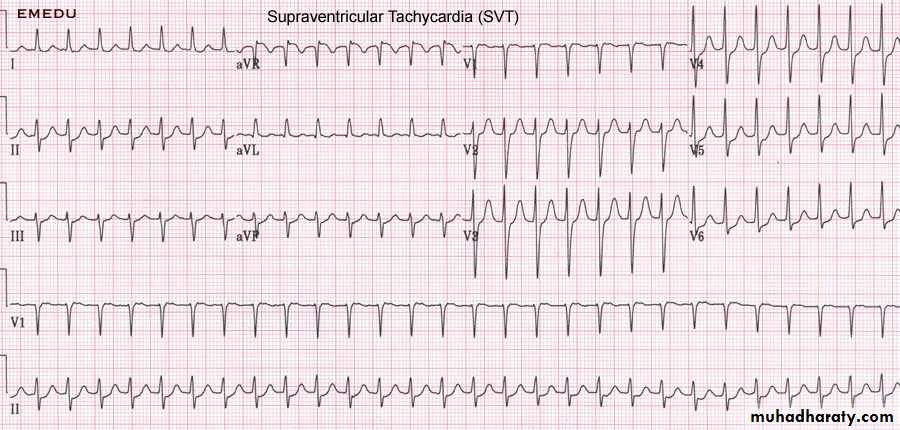 Supraventricular tachycardia
