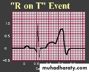 Supraventricular tachycardia