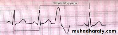 Supraventricular tachycardia