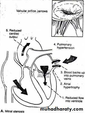 Valvular heart diseases