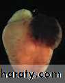 Valvular heart diseases