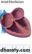 Valvular heart diseases