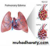 Valvular heart diseases