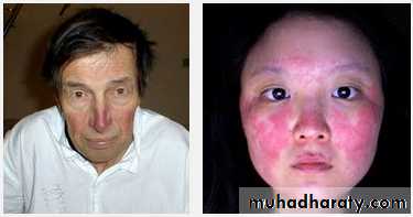 Valvular heart diseases