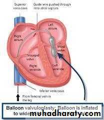 Valvular heart diseases