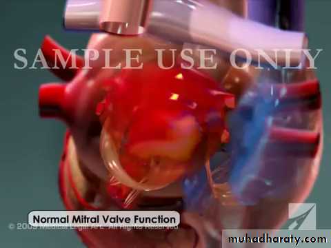 Valvular heart diseases