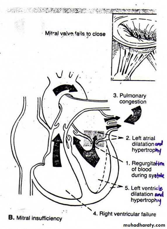 Valvular heart diseases