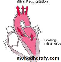 Valvular heart diseases