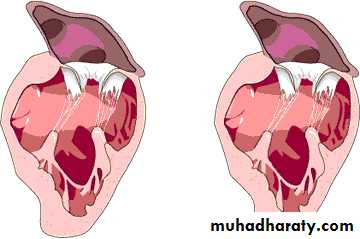 Valvular heart diseases