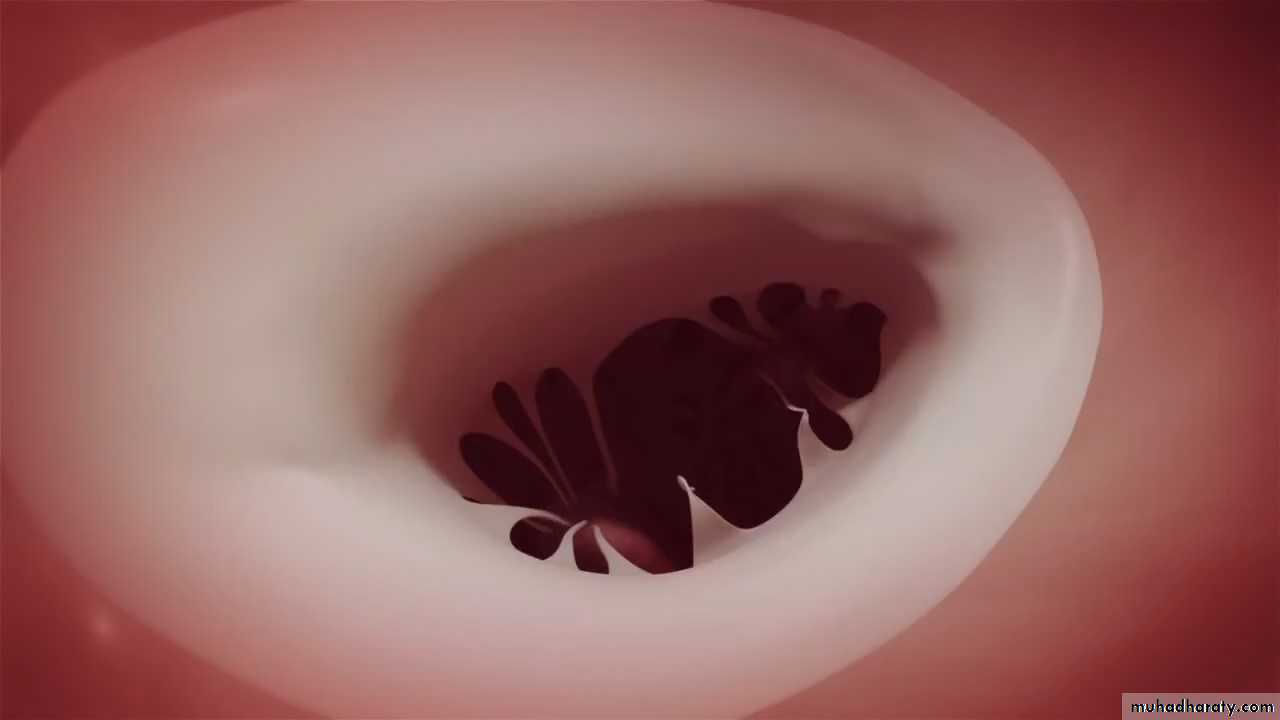 Valvular heart diseases