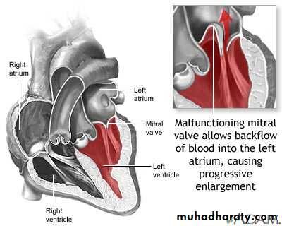 Valvular heart diseases