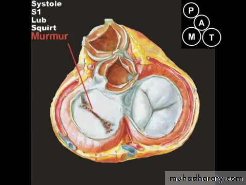 Valvular heart diseases