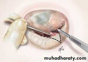 Valvular heart diseases