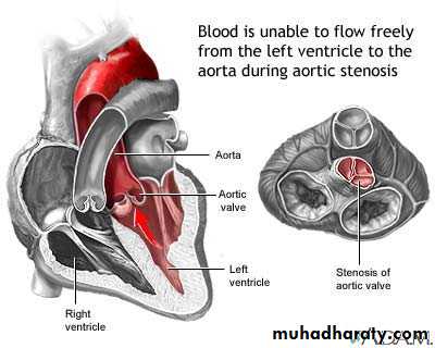 Valvular heart diseases