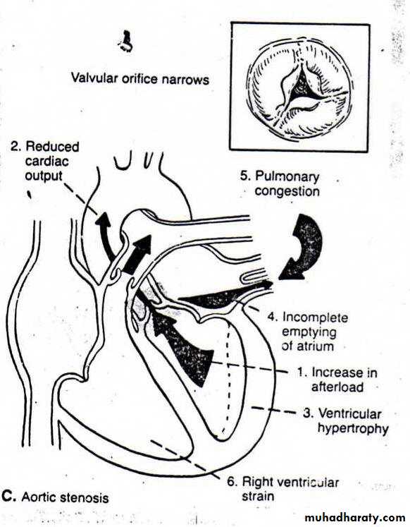 Valvular heart diseases