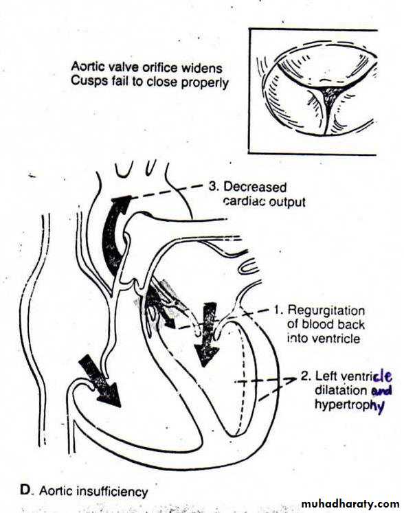 Valvular heart diseases