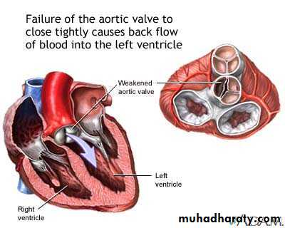 Valvular heart diseases