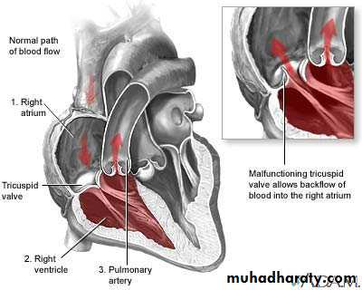Valvular heart diseases
