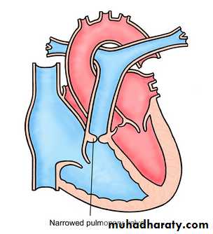 Valvular heart diseases