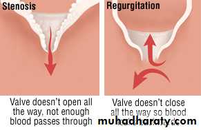 Valvular heart diseases