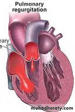 Valvular heart diseases
